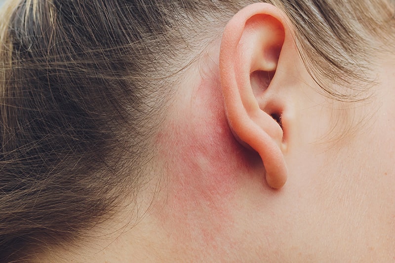 eczema de l'oreille