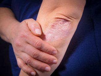 psoriasis avancé sur le coude