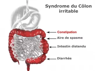 Syndrome du colon irritable